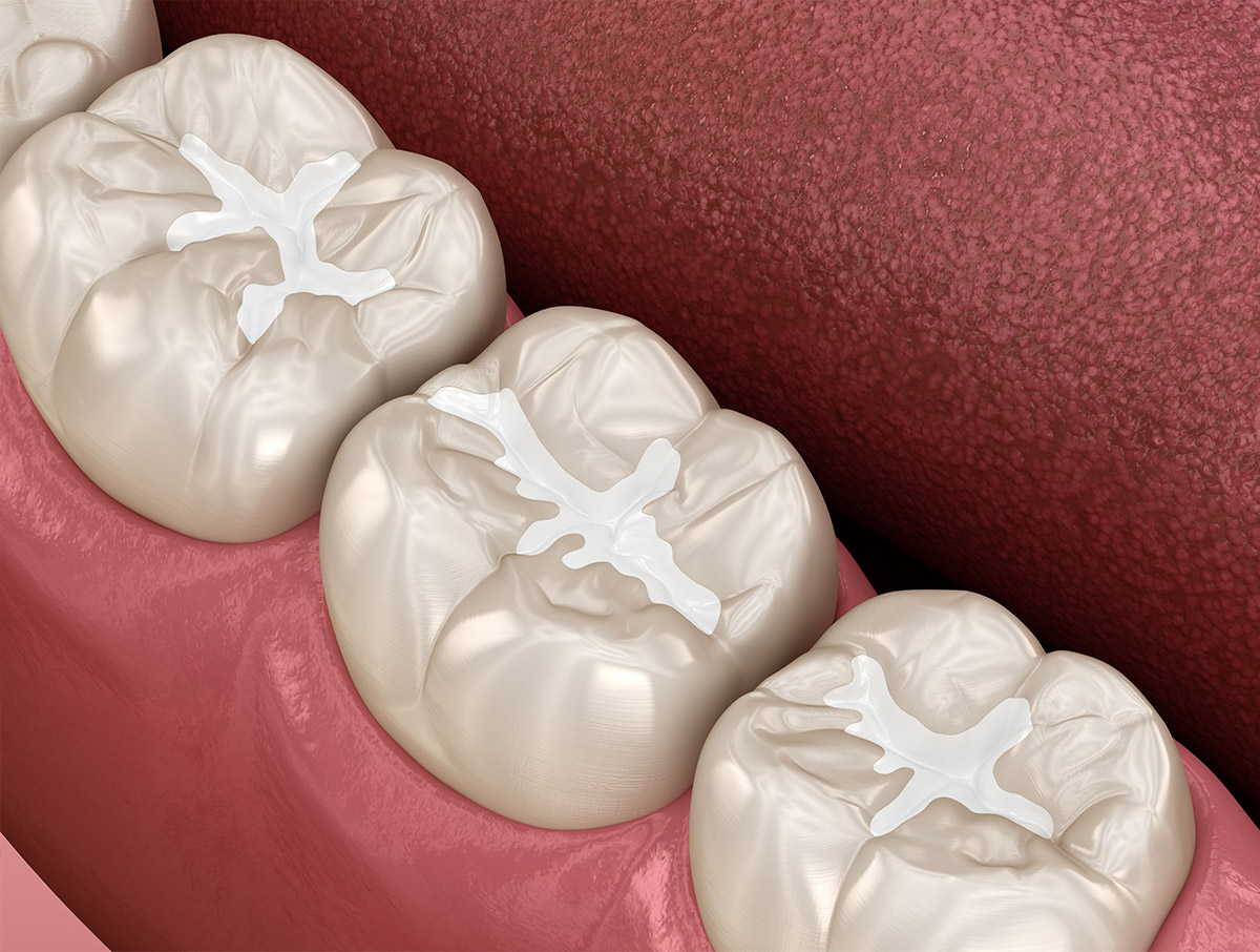 Dental Fillings in SW Calgary