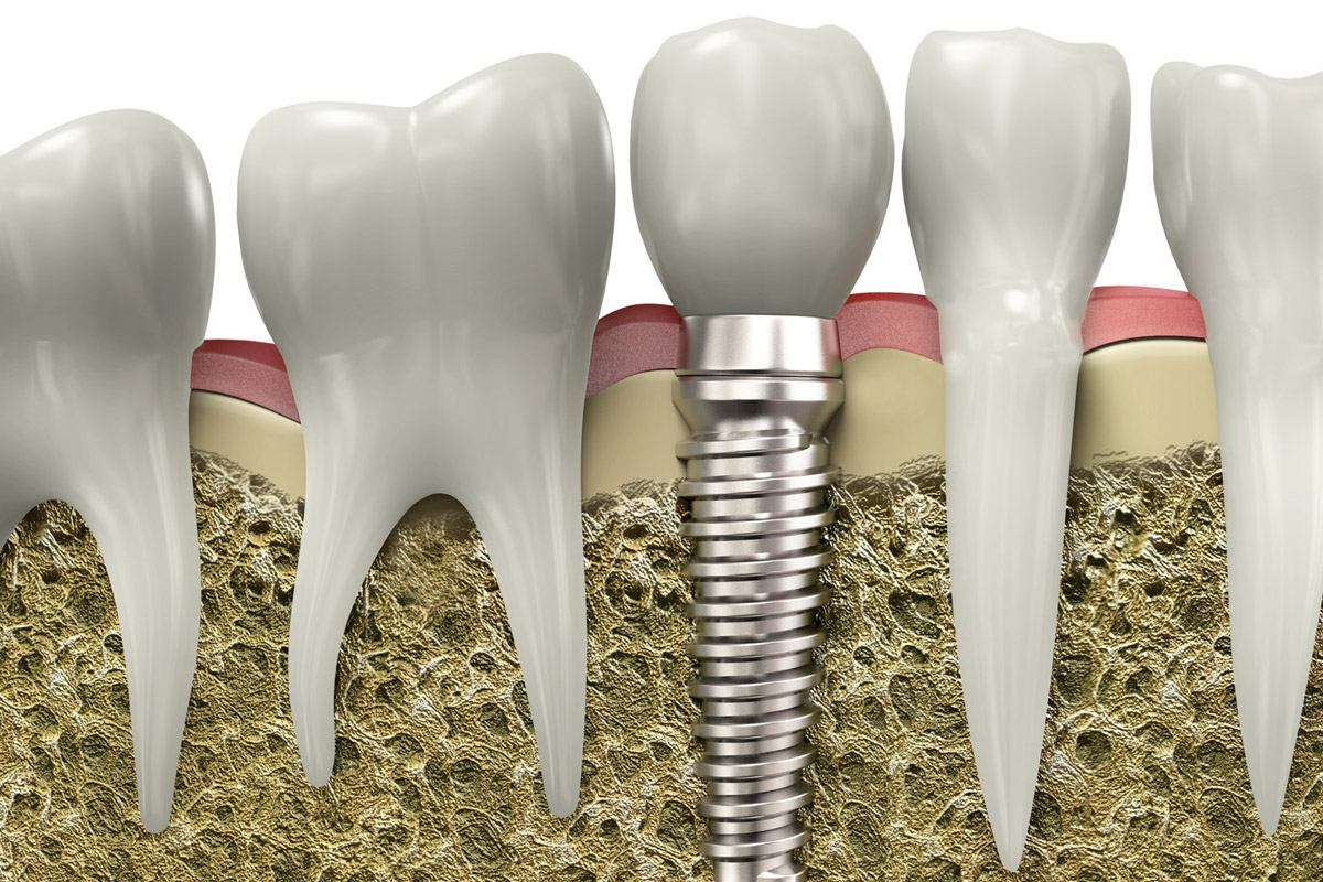 Implant Restorations in SW Calgary