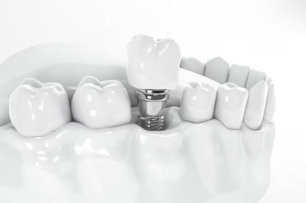 dental implants near you