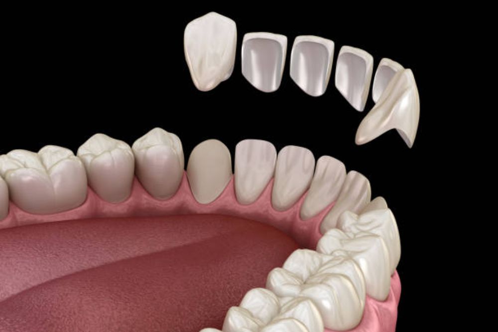 Porcelain Veneers in SW Calgary