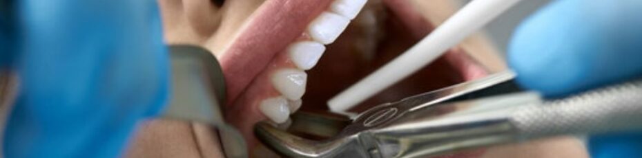 tooth extractions in SW Calgary