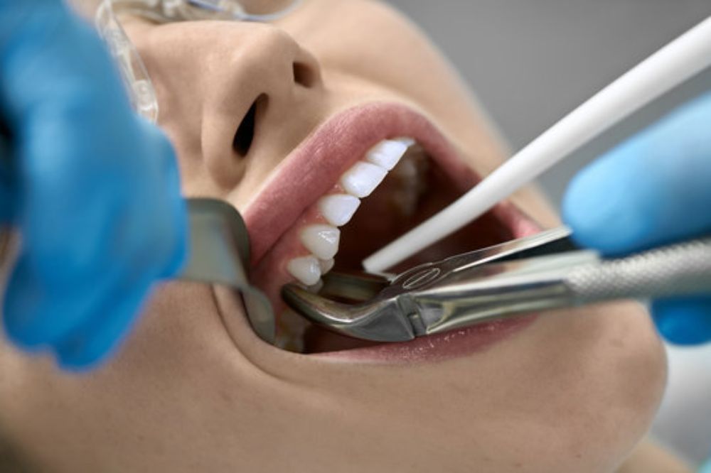 tooth extractions in SW Calgary