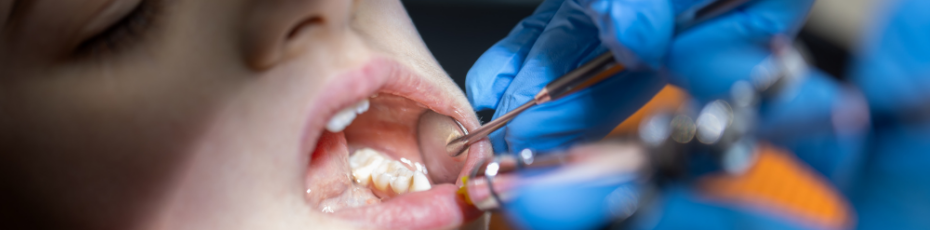 Tooth Extractions in SW Calgary