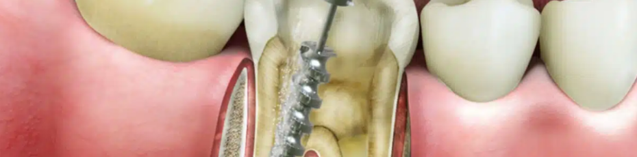 Root Canal Therapy Near You