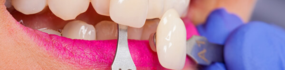 Porcelain Veneers Near Me