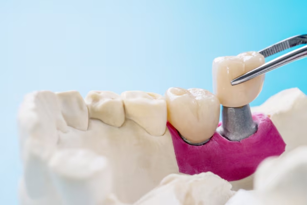 cracked tooth crown placement